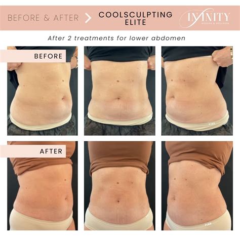 coolsculpting results timeline|coolsculpting in charlotte nc.